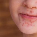 o-que-e-doenca-mao-pe-boca